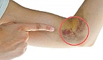 Những biểu hiện sớm của bệnh tiểu đường mà bạn nên đề phòng