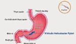 Cảnh báo độ nguy hiểm của vi khuẩn gây ung thư dạ dày