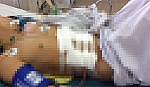 Cứu sống bệnh nhân bị vợ chém tràn ruột