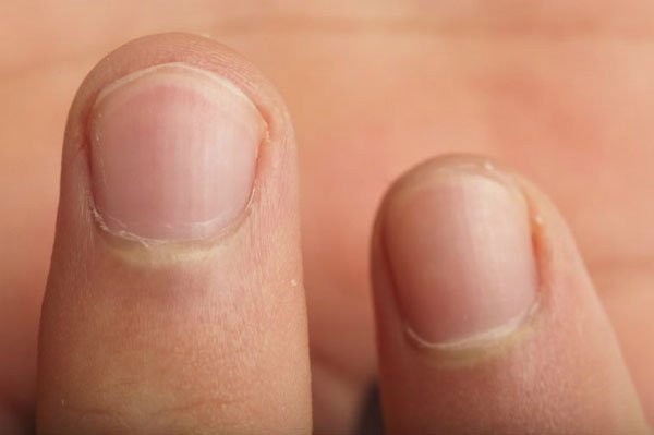 Cắn móng tay khiến răng dễ bị mòn, men răng nhiều vết nứt, khớp cắn bị sai vị trí. (Ảnh: Rd).