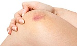 Những cách xóa tan vết bầm tím trên cơ thể