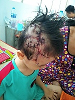 Bé 5 tuổi bị chó hàng xóm cắn thương tâm
