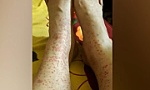 Bệnh viêm mao mạch dễ nhầm lẫn với nhiều loại bệnh lý khác