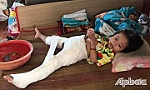 Xót xa cho bé Giàu bị thương tật khi còn quá nhỏ