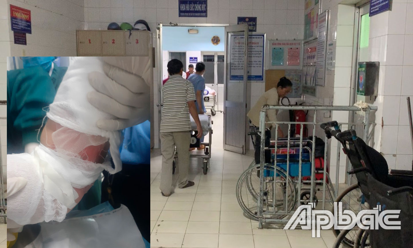 Bé trai bị bỏng 20% cấp cứu tại bệnh viên Đa khoa khu vực Cai Lậy
