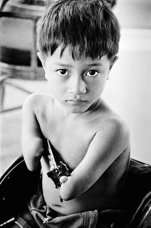 Nạn nhân chất độc da cam.
