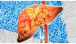 FDA Mỹ phê duyệt thuốc đầu tiên chữa viêm gan nhiễm mỡ không do rượu