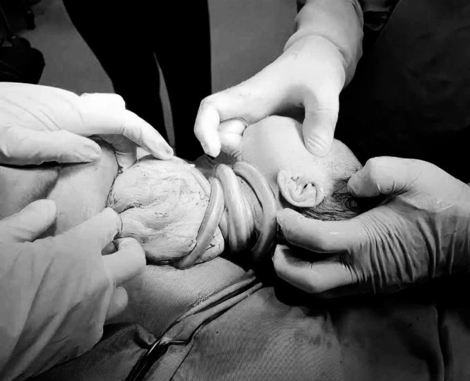 Bé gái chào đời với 6 vòng dây rốn quấn cổ